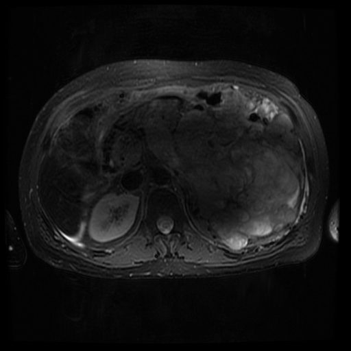 Acinar cell carcinoma of the pancreas (Radiopaedia 75442-86668 Axial T2 fat sat 33).jpg