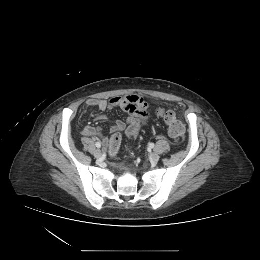Acinar cell carcinoma of the pancreas (Radiopaedia 75442-86669 Axial C+ portal venous phase 112).jpg