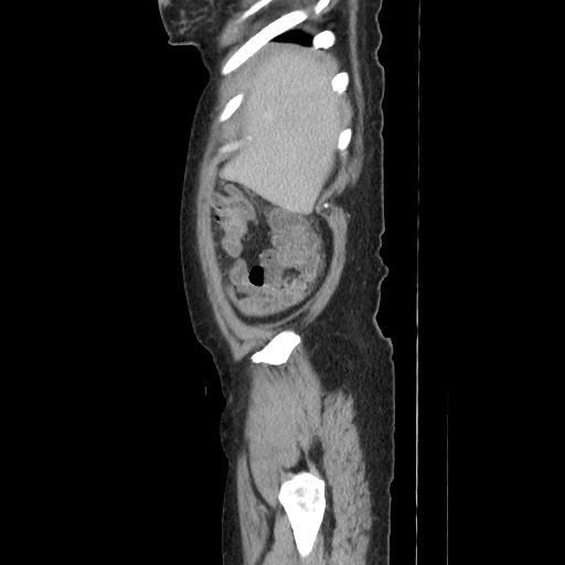 Acinar cell carcinoma of the pancreas (Radiopaedia 75442-86669 Sagittal C+ portal venous phase 35).jpg