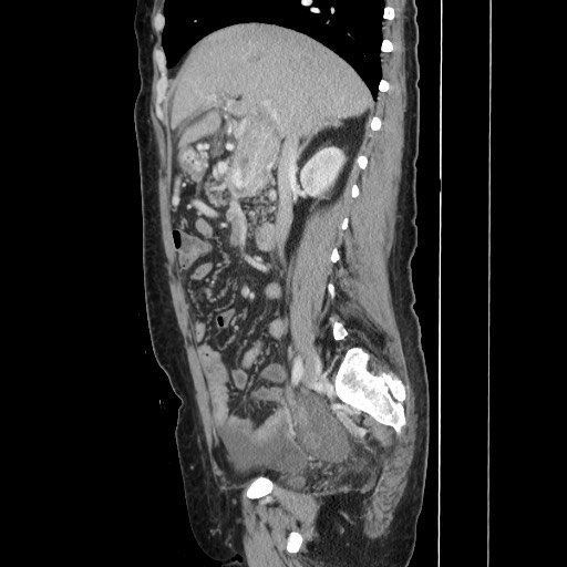 Acinar cell carcinoma of the pancreas (Radiopaedia 75442-86669 Sagittal C+ portal venous phase 79).jpg