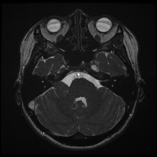 File:Acoustic neuroma (Radiopaedia 34049-35283 Axial 58).png