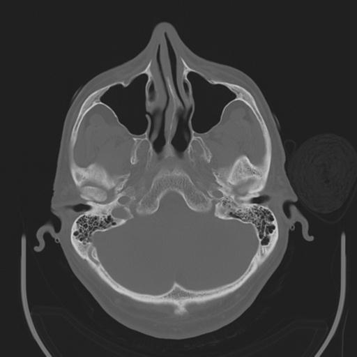 File:Acoustic schwannoma (Radiopaedia 29488-29982 AXIAL BONE THICK non-contrast 9).jpg