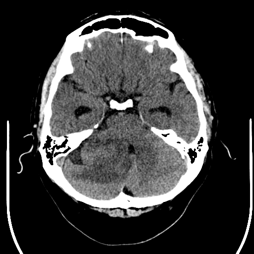 File:Acoustic schwannoma (Radiopaedia 39170-41389 Axial non-contrast 8).png