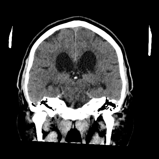 File:Acoustic schwannoma (Radiopaedia 55729-62280 Coronal non-contrast 24).png