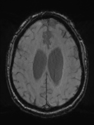 Acoustic schwannoma (Radiopaedia 55729-62281 Axial SWI 37).png