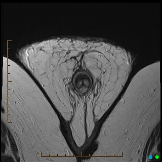 File:Acquired buried penis (Radiopaedia 39478-41797 Axial T2 32).jpg