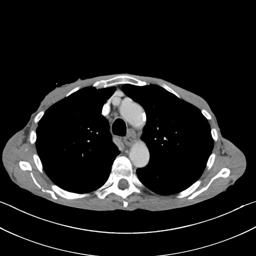 File:Acquired tracheoesophageal fistula (Radiopaedia 57747-65042 Axial C+ portal venous phase 30).jpg