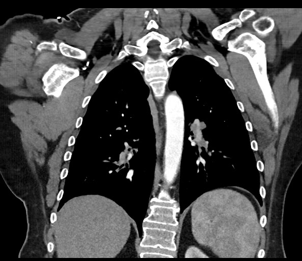 Acromioclavicular joint cyst (Radiopaedia 58455-65610 Coronal C+ arterial phase 97).jpg