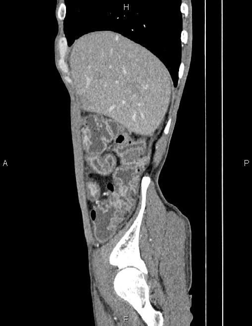 Active crohn disease (Radiopaedia 87133-103397 Sagittal C+ arterial phase 13).jpg