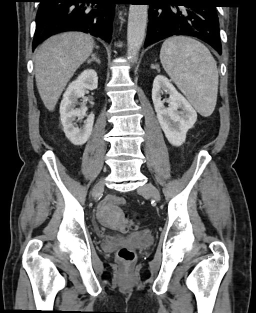 Active lower gastrointestinal bleeding - diverticular (Radiopaedia 61203-69106 Coronal C+ portal venous phase 88).jpg
