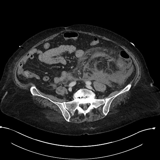File:Active renal extravasation with large subcapsular and retroperitoneal hemorrhage (Radiopaedia 60975-68796 Axial 246).jpg