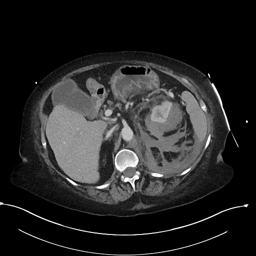 File:Active renal extravasation with large subcapsular and retroperitoneal hemorrhage (Radiopaedia 60975-68796 Axial 287).jpg