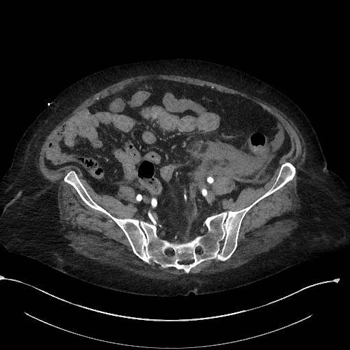 File:Active renal extravasation with large subcapsular and retroperitoneal hemorrhage (Radiopaedia 60975-68796 Axial C+ arterial phase 143).jpg