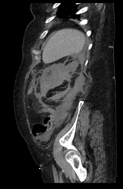 Active renal extravasation with large subcapsular and retroperitoneal hemorrhage (Radiopaedia 60975-68796 Sagittal C+ portal venous phase 62).jpg