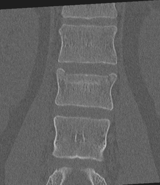 Acute L1 burst compression fracture (Radiopaedia 34430-35755 Coronal bone window 30).png