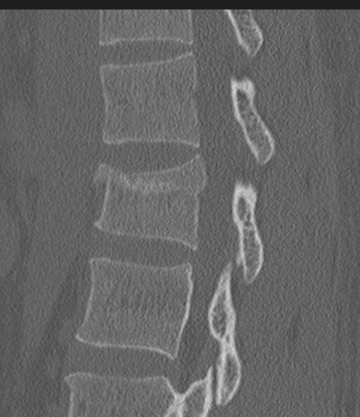 Acute L1 burst compression fracture (Radiopaedia 34430-35755 Sagittal bone window 28).png