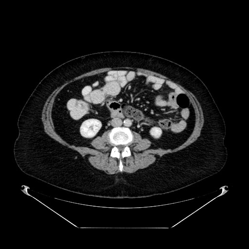 File:Acute appendicitis, heterotaxy syndrome (Radiopaedia 66884-76202 Axial C+ portal venous phase 70).jpg