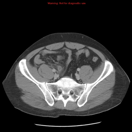 Acute appendicitis (Radiopaedia 10498-10973 Axial C+ portal venous phase 32).jpg