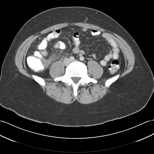 Acute appendicitis (Radiopaedia 30297-30934 Axial C+ portal venous phase 51).jpg