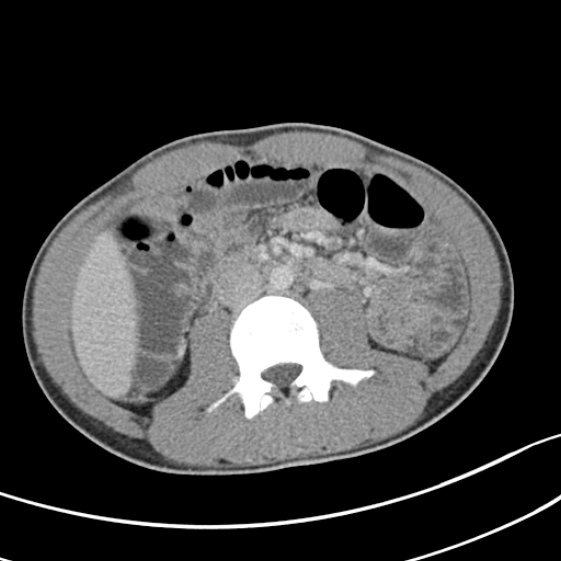 Acute appendicitis (Radiopaedia 32614-33572 Axial C+ portal venous phase 30).jpg