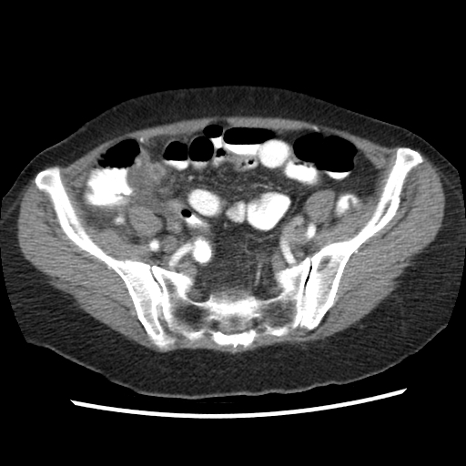 File:Acute appendicitis (Radiopaedia 52672-58589 Axial C+ arterial phase 19).jpg