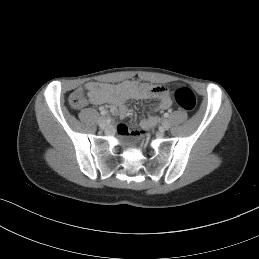 Acute appendicitis (Radiopaedia 62608-70901 Axial C+ portal venous phase 18).jpg