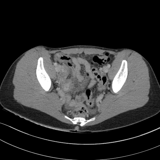 File:Acute appendicitis (Radiopaedia 62608-70901 Axial C+ portal venous phase 37).jpg