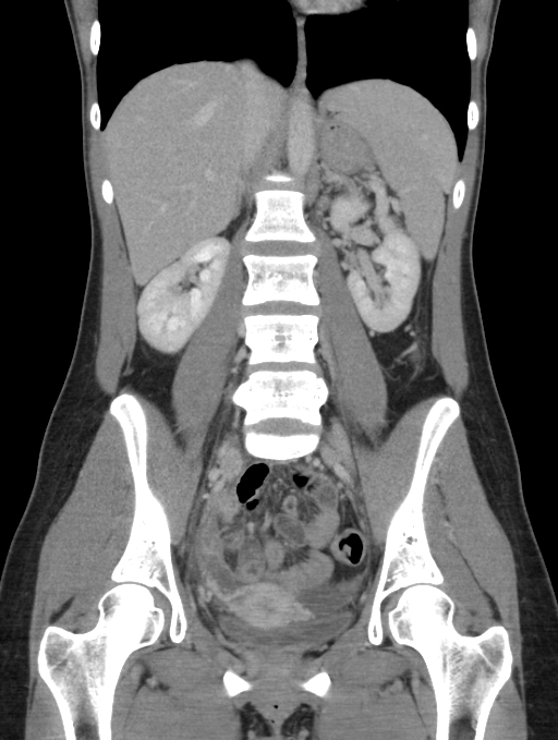 Acute appendicitis (Radiopaedia 62608-70901 Coronal C+ portal venous phase 30).jpg