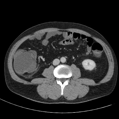 Acute appendicitis (Radiopaedia 66513-75790 Axial C+ portal venous phase 44).jpg