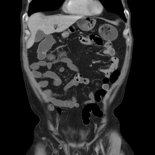 Acute appendicitis (Radiopaedia 66513-75790 Coronal C+ portal venous phase 12).jpg