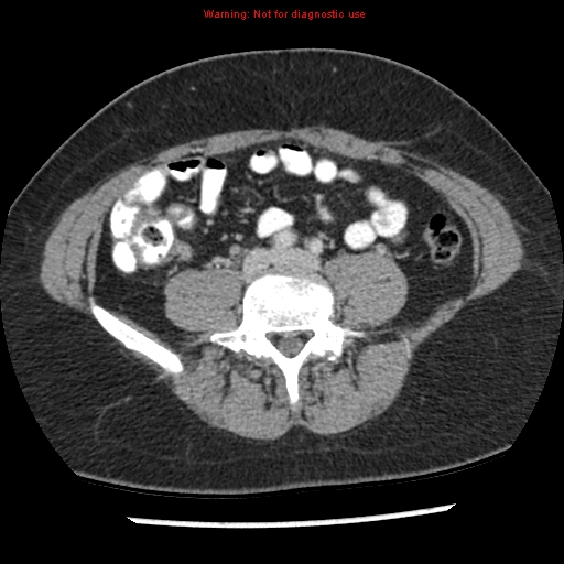 File:Acute appendicitis (Radiopaedia 7966-8812 C+ portal venous phase 32).jpg