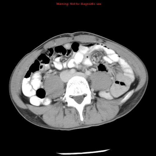 Acute appendicitis (Radiopaedia 8195-9045 Axial C+ portal venous phase 46).jpg