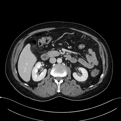 Acute appendicitis - large appendicoliths (Radiopaedia 61805-69820 Axial C+ portal venous phase 52).jpg