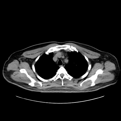 Acute appendicitis and COVID 19 pneumonia (Radiopaedia 76604-88380 Axial non-contrast 14).jpg