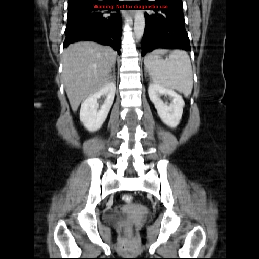 Acute appendicitis complicated by ovarian vein thrombophlebitis (Radiopaedia 16172-15851 Coronal C+ portal venous phase 57).jpg