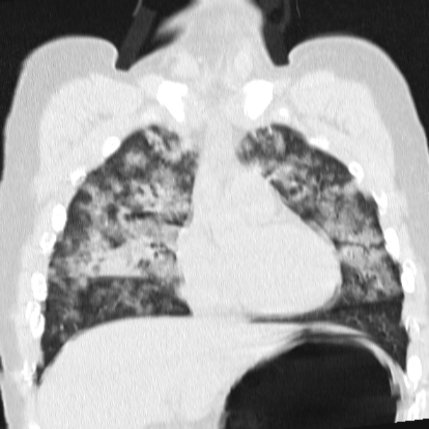 Acute aspiration pneumonitis (Radiopaedia 33605-34703 Coronal lung window 33).jpg