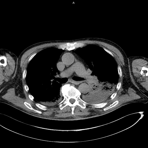 Acute aspiration pneumonitis (Radiopaedia 55642-62166 Axial liver window 28).jpg