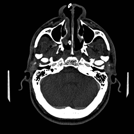 Acute basilar artery occlusion (Radiopaedia 43582-46985 Axial C+ arterial phase 76).jpg