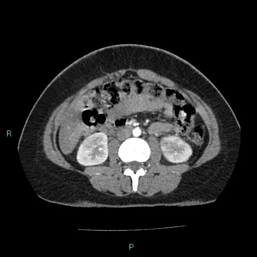 Acute bilateral pyelonephritis (Radiopaedia 37146-38881 Axial C+ arterial phase 97).jpg