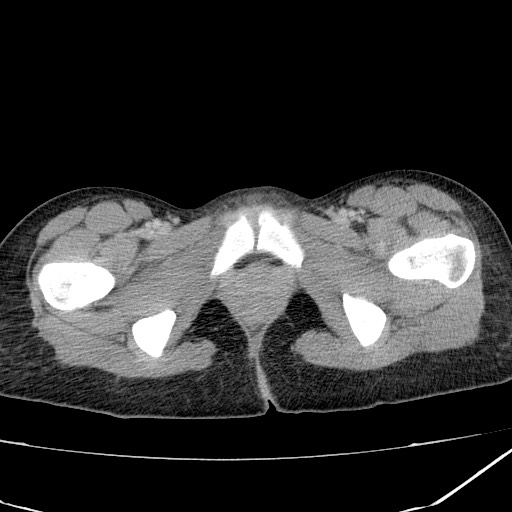 Acute bilateral pyelonephritis (Radiopaedia 74153-84969 Axial C+ portal venous phase 52).jpg