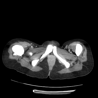 File:Acute calculous cholecystitis in patient with osteopetrosis (Radiopaedia 77871-90159 Axial C+ portal venous phase 83).jpg