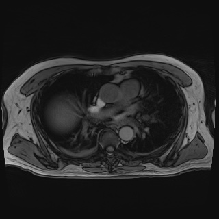 Acute cholecystitis (Radiopaedia 72392-82923 Axial T1 out-of-phase 5).jpg