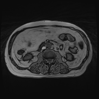 File:Acute cholecystitis (Radiopaedia 72392-82923 Axial T1 out-of-phase 77).jpg