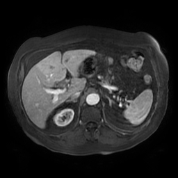 Acute cholecystitis complicated by pylephlebitis (Radiopaedia 65782-74915 Axial arterioportal phase T1 C+ fat sat 48).jpg