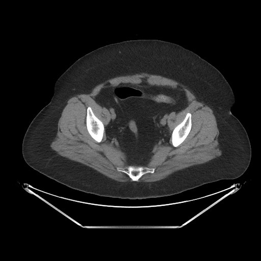 Acute cholecystitis with tensile fundus sign (Radiopaedia 71394-81723 Axial non-contrast 100).jpg