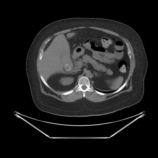 Acute cholecystitis with tensile fundus sign (Radiopaedia 71394-81723 Axial non-contrast 16).jpg