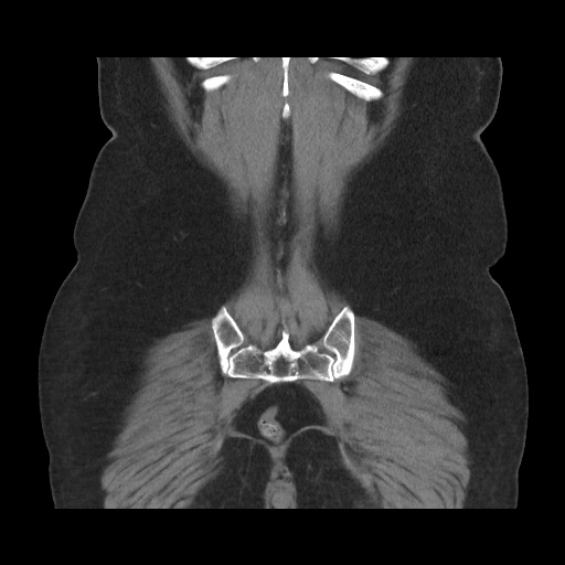 Acute cholecystitis with tensile fundus sign (Radiopaedia 71394-81723 Coronal non-contrast 103).jpg