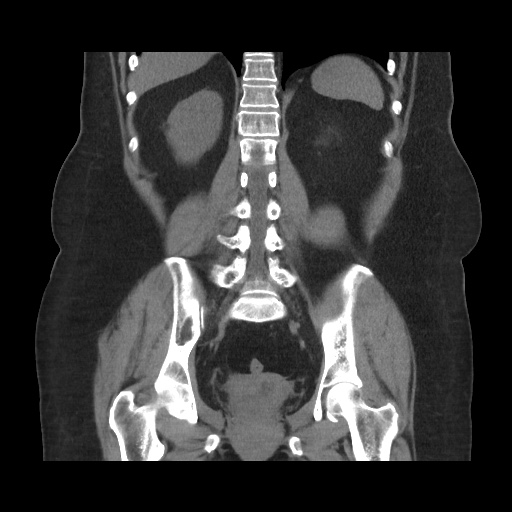 Acute cholecystitis with tensile fundus sign (Radiopaedia 71394-81723 Coronal non-contrast 85).jpg