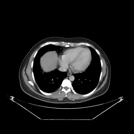 File:Acute complicated calculous cholecystitis (Radiopaedia 55202-61587 Axial C+ delayed 16).jpg