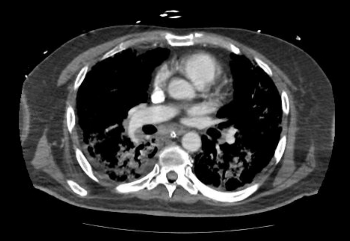 Acute cor pulmonale (ultrasound) (Radiopaedia 83508-98818 Axial C+ CTPA 39).jpg